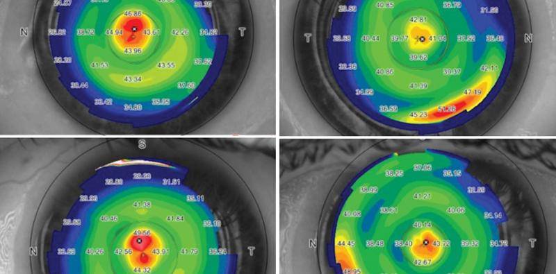 Allograft Lenticules for the Treatment of Presbyopia