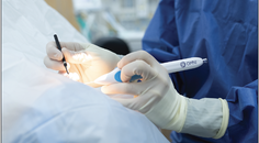 Unparalleled Versatility in Implant Free MIGS