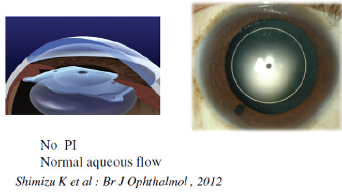 EVO Visian ICL 10 Years of Follow Up