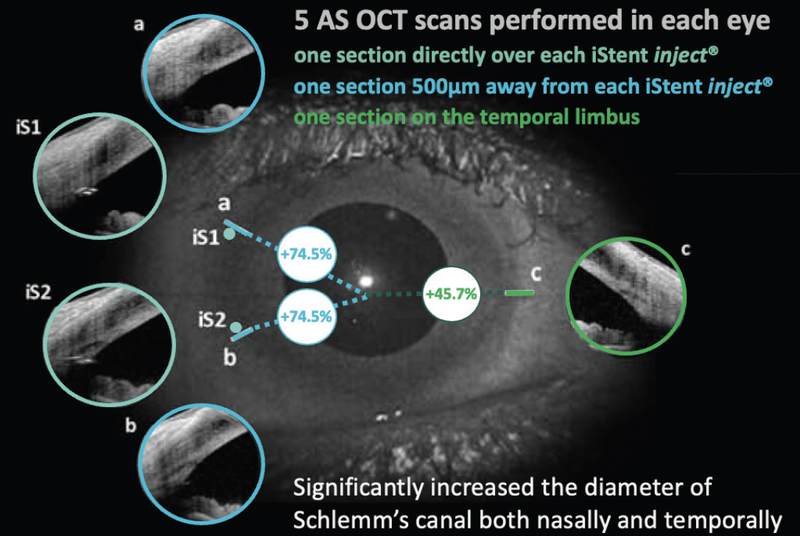 Trabecular Micro Bypass for the Treatment of Glaucoma