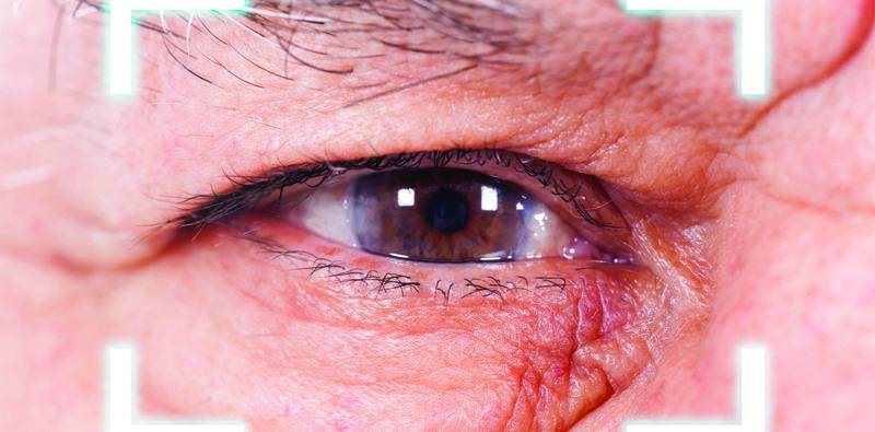 Secondary IOL Implantation After Complicated Primary Surgery