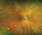 Use of UWF Retinal Imaging in Cataract Surgery