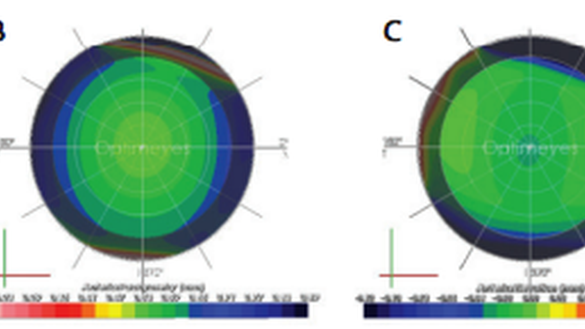 Optimization of Surgical Treatments in the Cornea