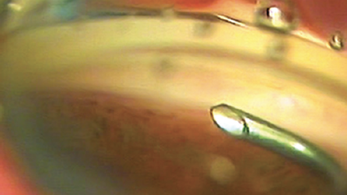 Early Experience With the OMNI Surgical System