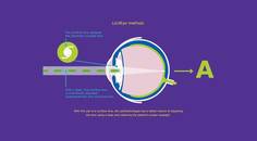 Overcoming the Butterfly Effect in Refractive Cataract Surgery