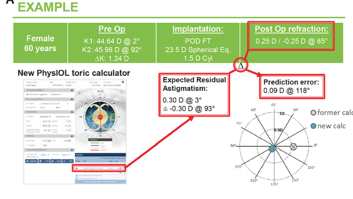 Refractive Astigmatism Outcomes With the Abulafia Koch Formula