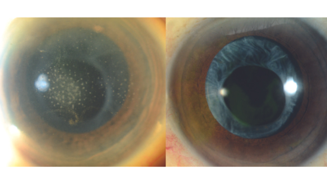 Treating Herpes Simplex and Varicella Anterior Uveitis