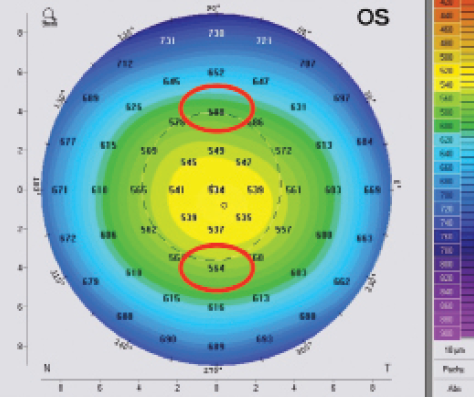 A 12-Point Algorithm to Master Corneal Tomography