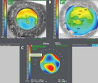 What Makes a Good Refractive Surgeon