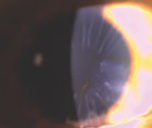 A Patient With Dry AMD Desires Improved Vision