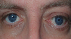 Managing Thyroid Eye Disease