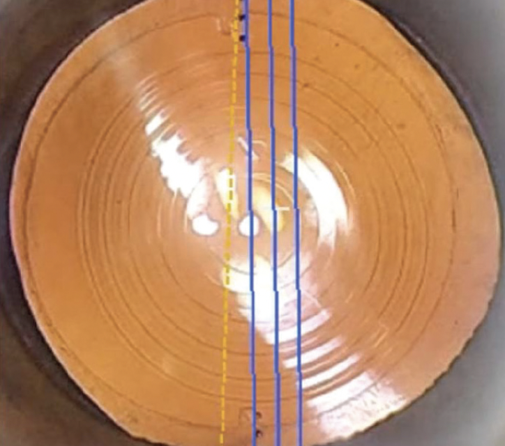 The Advantages of High Precision Cataract Surgery