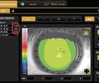 Elevating Your Orthokeratology Fitting Using Topography and Biometry for Myopia Control