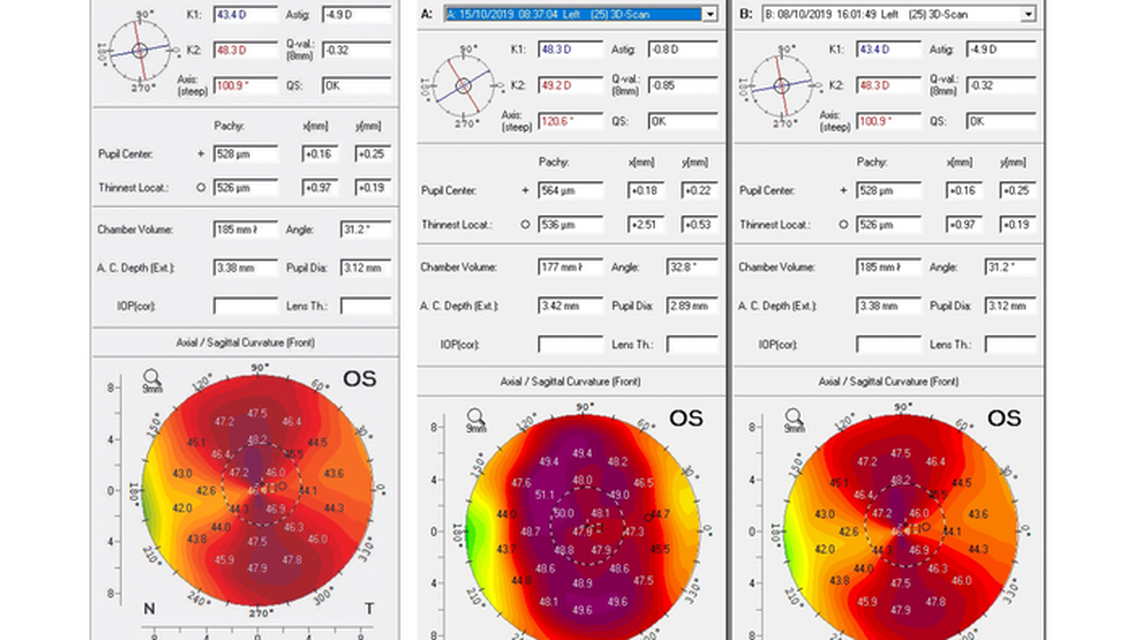 High Astigmatism and Amblyopia