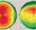 Preoperative Steps in Presbyopic Cataract Surgery