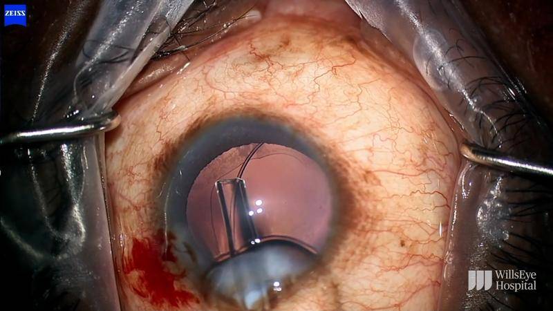 Zonulopathy in Primary AngleClosure Disease thumbnail