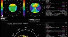 Advancing Cataract Surgery With Diagnostic Technologies
