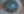 Figure 1. Failed PKP in a patient with limbal stem cell deficiency.