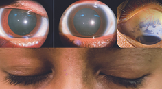 Nevus of Ota
