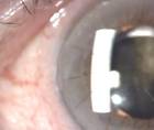Worsening Vision From a Dislocated IOL