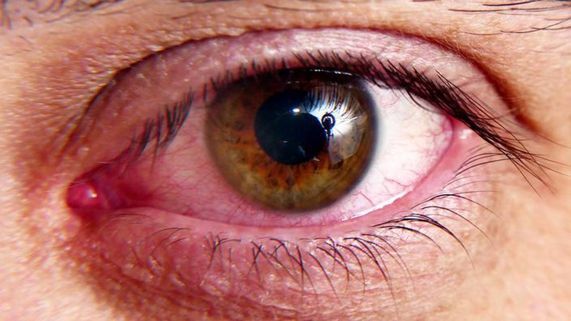 Treating Dry Eye Associated With Meibomian Gland Dysfunction