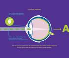 Overcoming the Butterfly Effect in Refractive Cataract Surgery
