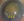 Figure 4. A hard cataract with compromised zonules (yellow arrows).