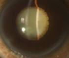 Is Lens Surgery The New LASIK