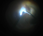 Surgery for an Infant With Stage5 Familial Exudative Vitreoretinopathy thumbnail