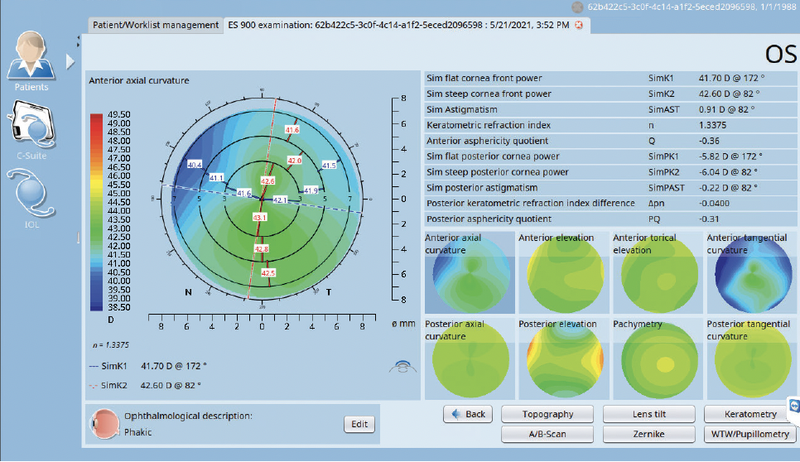 Clinical Value and Use of the Eyestar 900s Cataract Suite