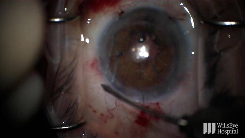 Traumatic Cataract With Repeat Pupillary Cerclage Under a Penetrating Keratoplasty thumbnail