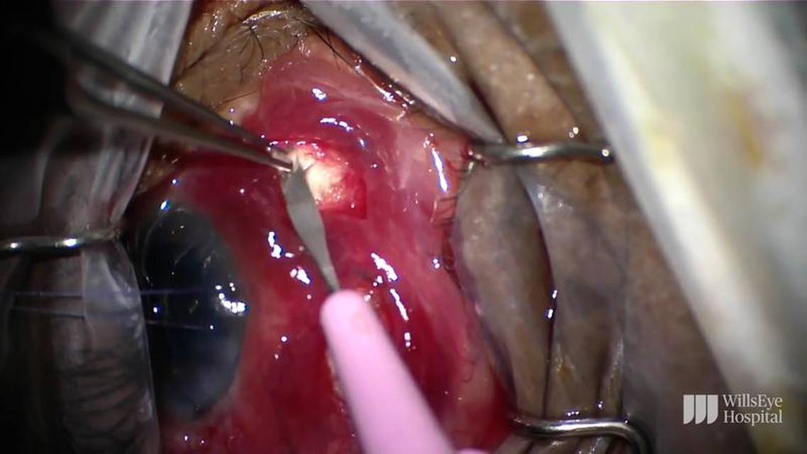 Choroidal Effusion Drainage and Cataract Removal thumbnail