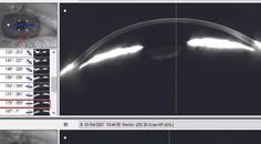 Refractive Surgery and Glaucoma