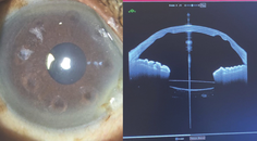 Atypical Corneal Flattening