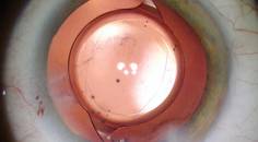 Indications for Posterior Capsulorhexis and Posterior Optic Capture