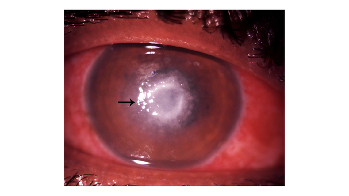 A Rare Case of Pythium Keratitis Masquerading as Fungal Keratitis