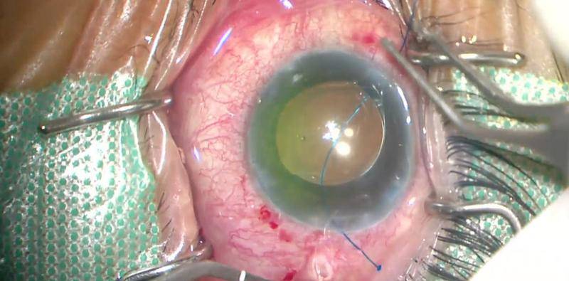 Flanged Technique for Capsular Tension Segment Fixation