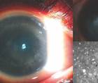 Acanthamoeba Keratitis