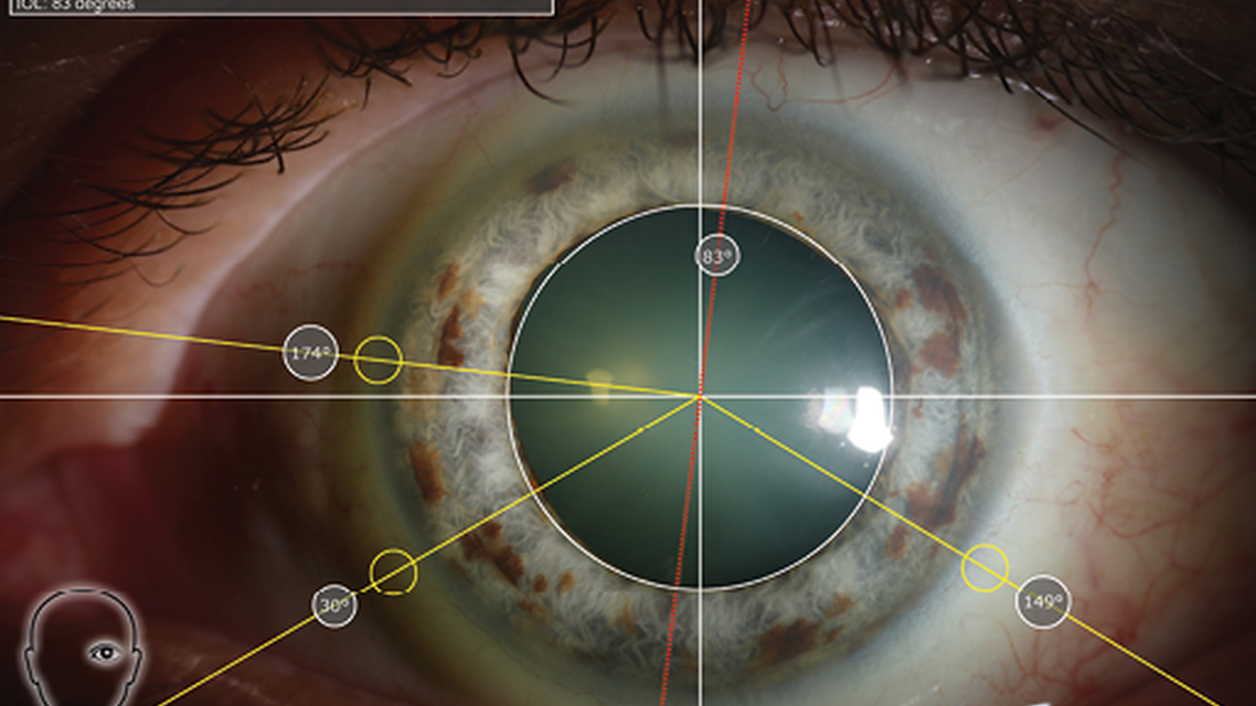 The Role of Iris Fingerprinting in Toric IOL Alignment