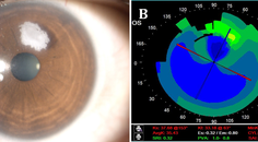 Epithelial Ingrowth After Laser Assisted Lenticule Extraction