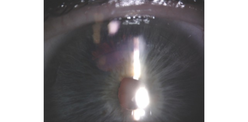 Transillumination Defects After the Implantation of a One Piece IOL in the Bag