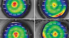 Allograft Lenticules for the Treatment of Presbyopia
