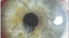 Complications of Small Pupil Cataract Surgery