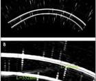 Epithelial Thickness An Indicator for Early Keratoconus