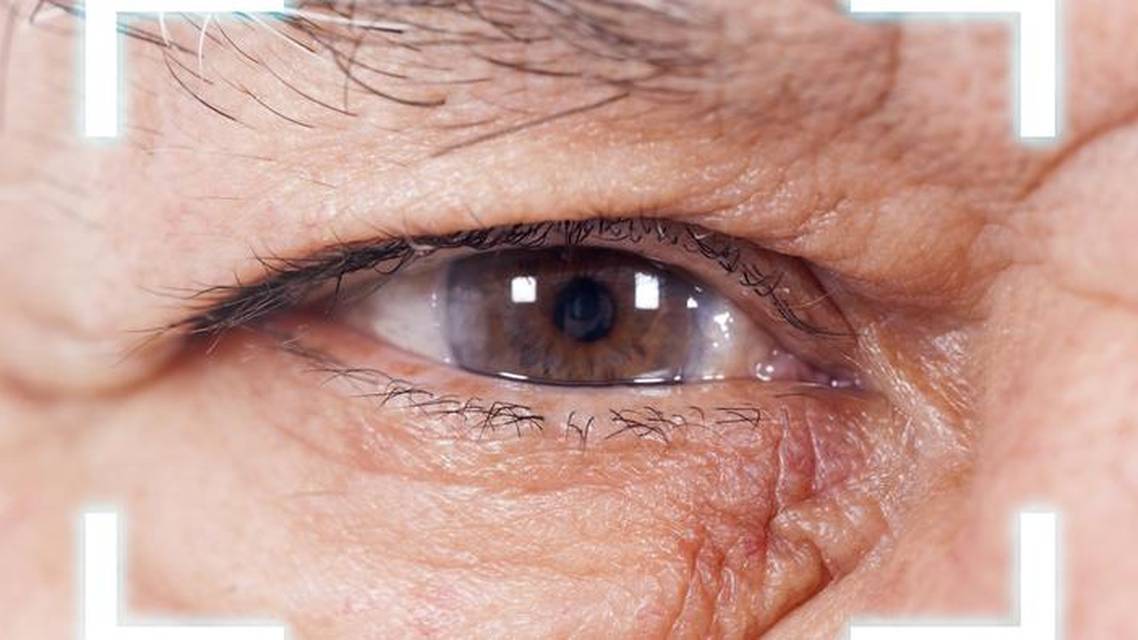 Radial Keratotomy and Salzmann Nodular Degeneration