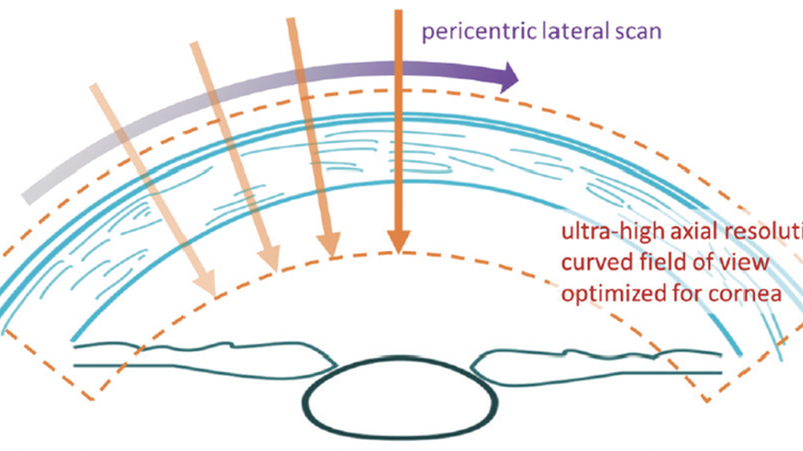 Redefining Corneal Tomography Introducing the Pentacam Cornea OCT