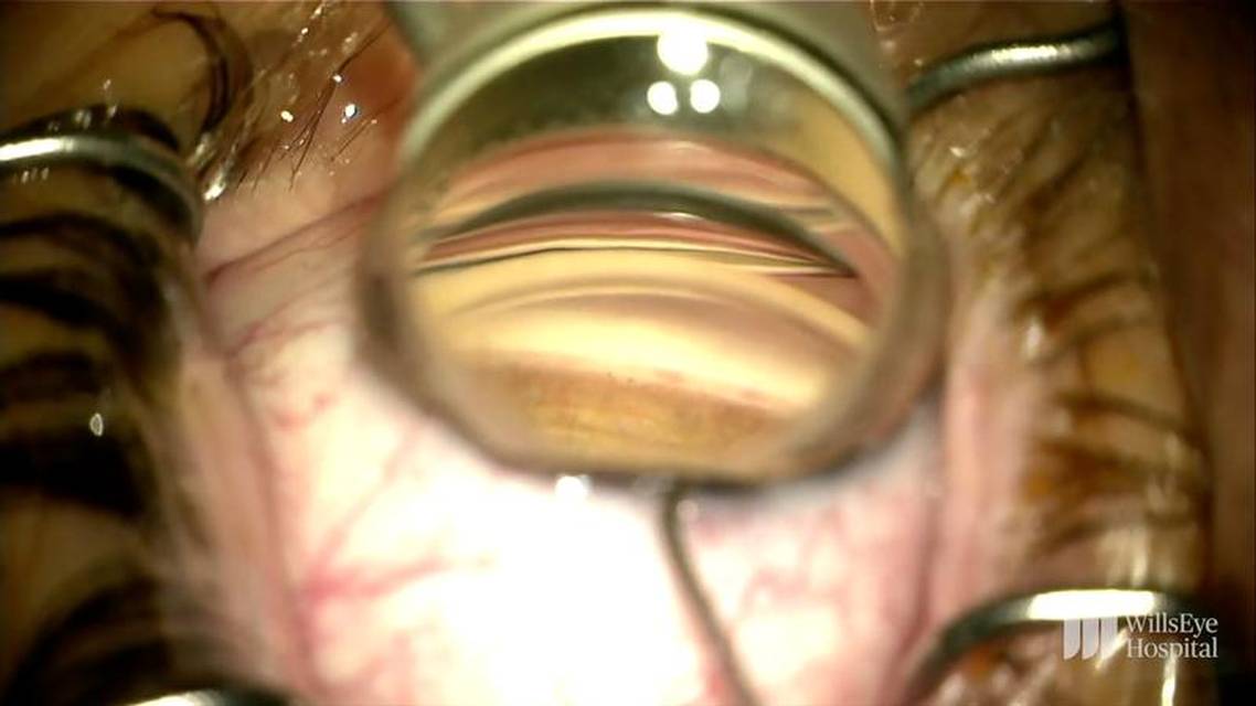 Combining Cataract and Glaucoma Surgery thumbnail