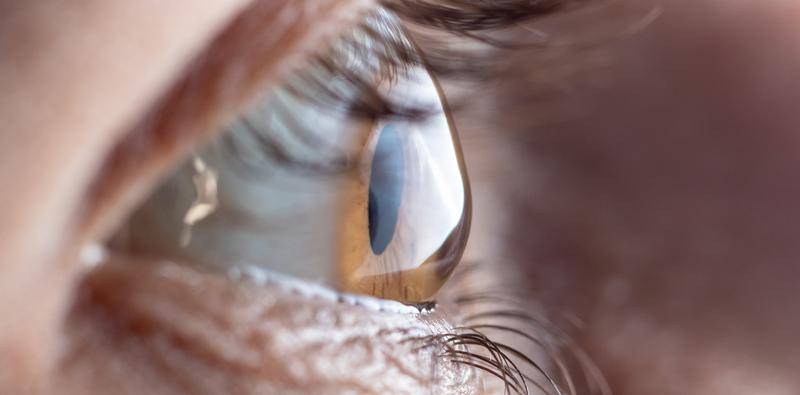 IOL Calculations for Patients With Keratoconus