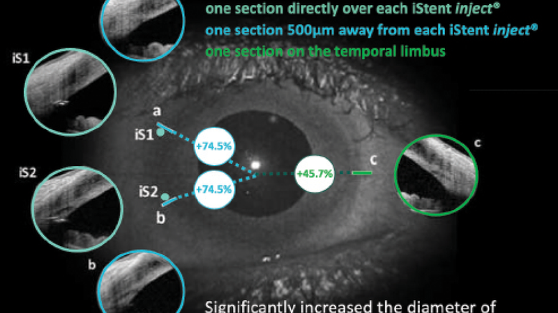 Trabecular Micro Bypass for the Treatment of Glaucoma