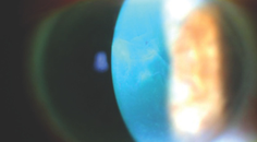 High Myopia After Cataract Surgery